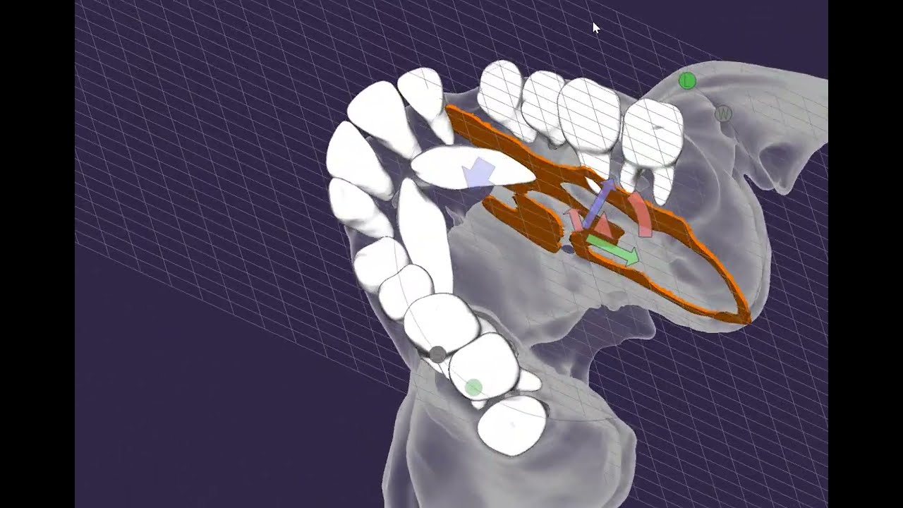 Localization of impacted canines for orthodontic traction
