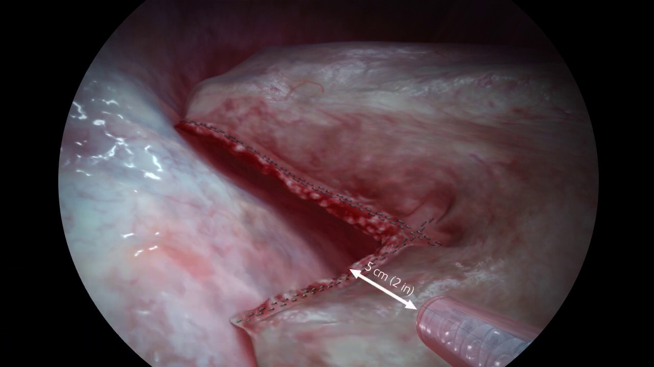 Progel Pleural Air Leak Sealant Inservice Video: Application