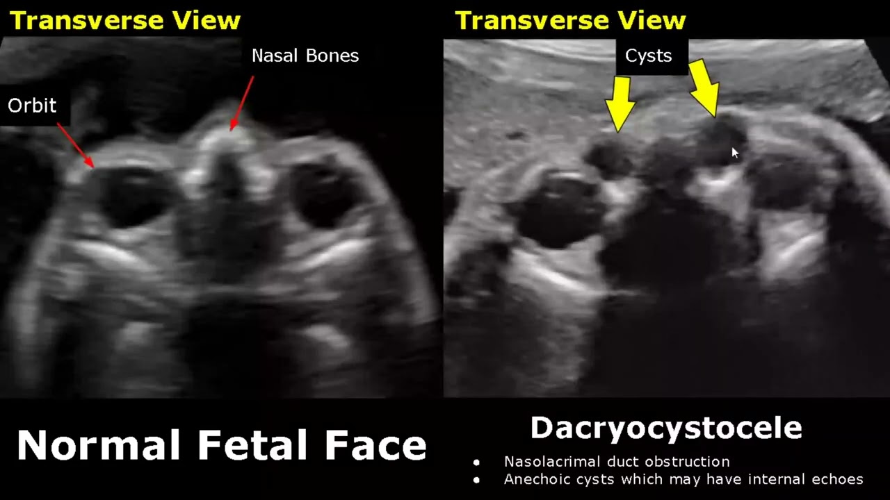 Fetal Face Ultrasound Normal Vs Abnormal Image Appearances | Eye Abnormalities | Obstetric USG