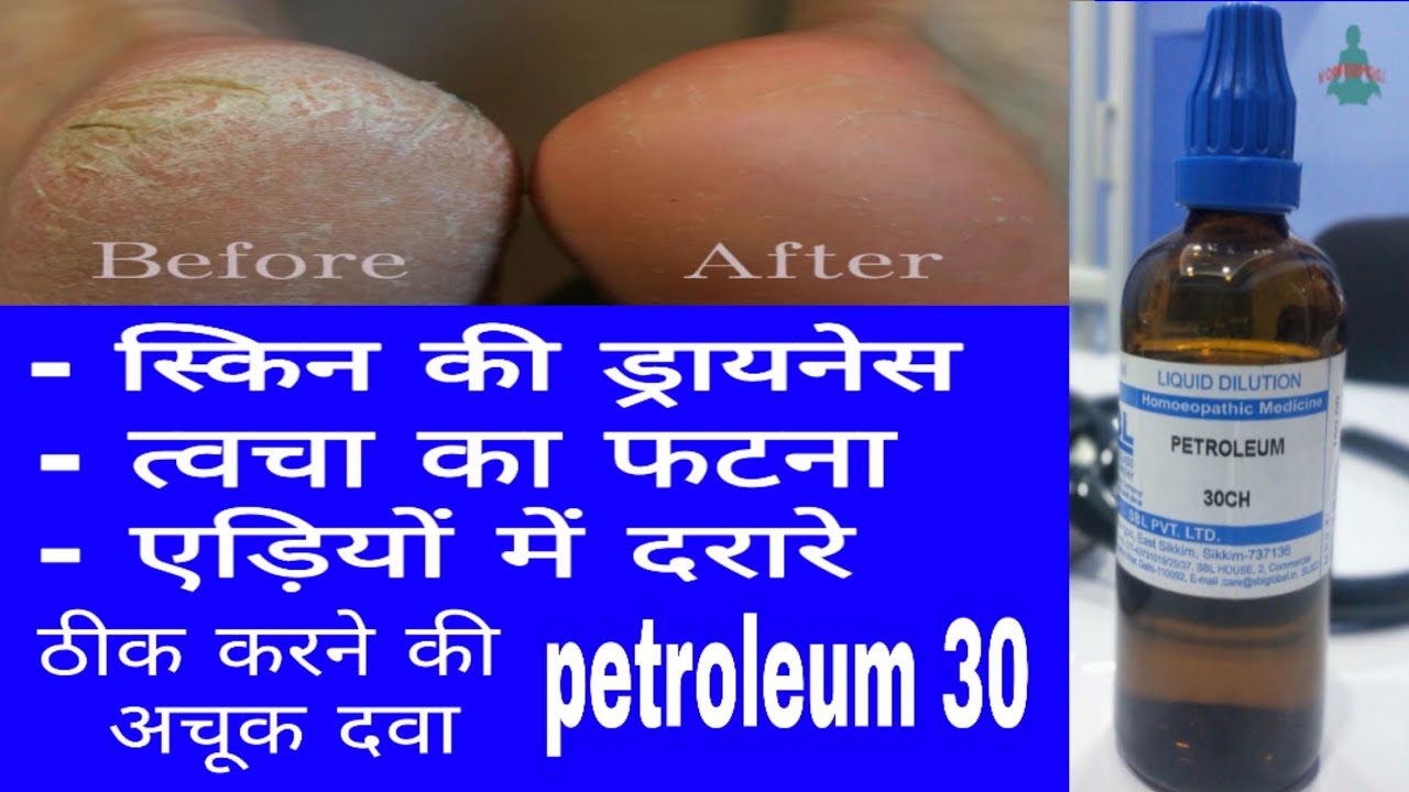 petroleum 30 | best medicine for cracked heels | best medicine for winter problem | cracked skin