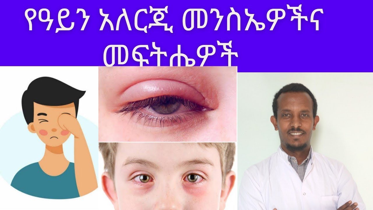 የዓይን አለርጂ መንስኤዎች እና መፍትሔዎች Causes and treatment of Allergic eye disease