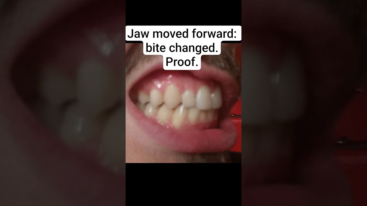 #Jaw moved forward. Proof: bite changed.
