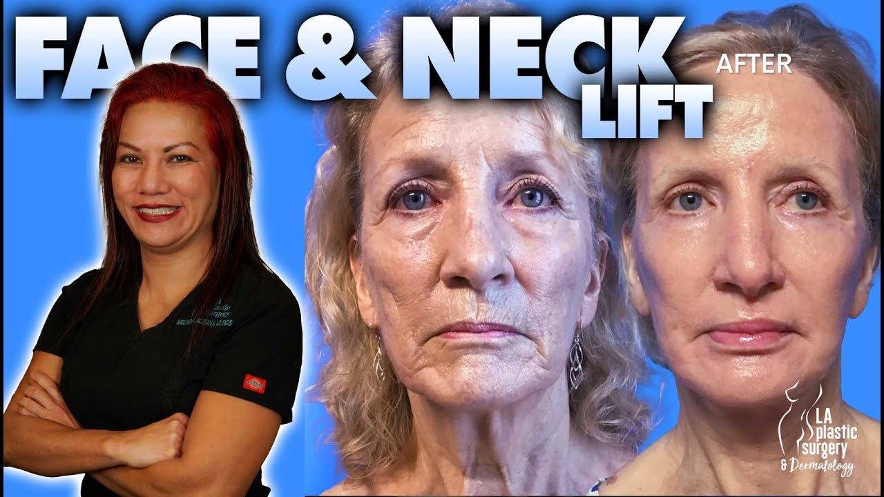 Facelift, Necklift, Skin Resurfacing - Plasma Lyft (formerly Trifecta Facelift) By Dr. Lacerna