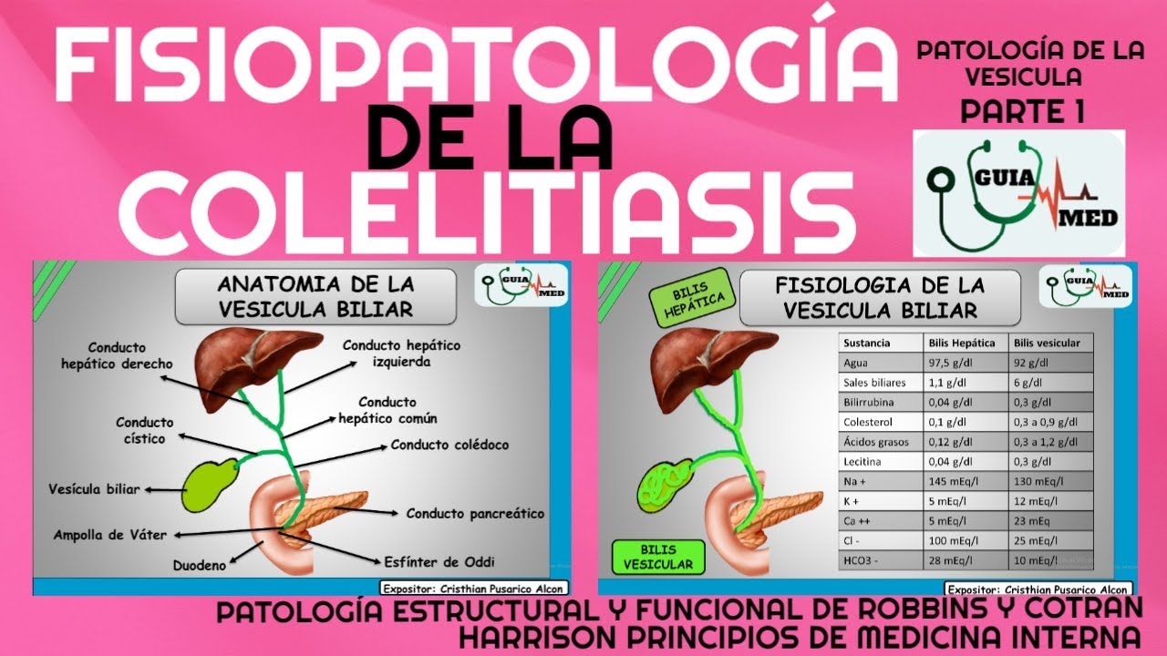 COLELITIASIS FISIOPATOLOGÍA| GuiaMed