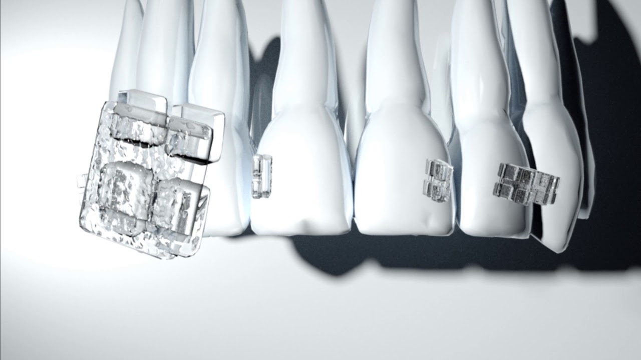Purity Plus Sapphire Bracket System