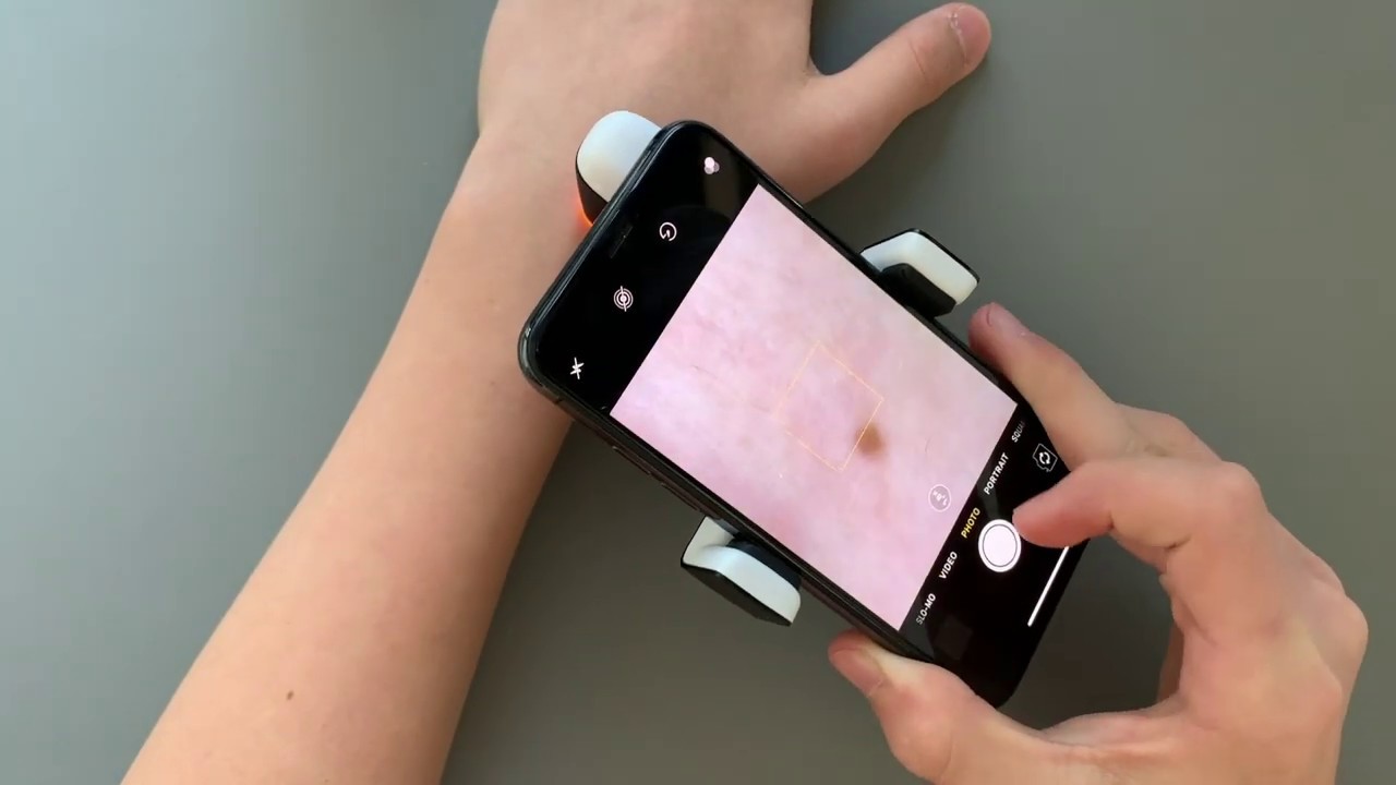 How to use DermLite HÜD to take photos of your skin lesions