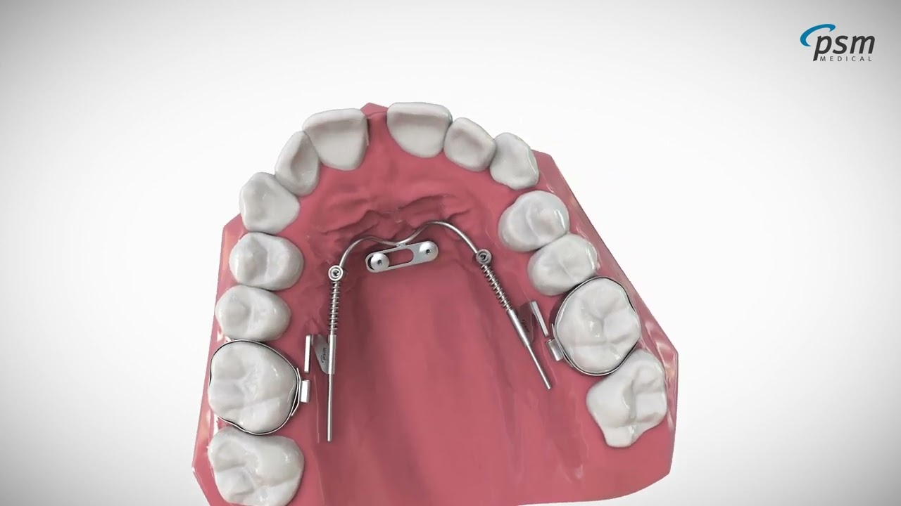 PSM - The BENEfit System for Distalization and Mesialization