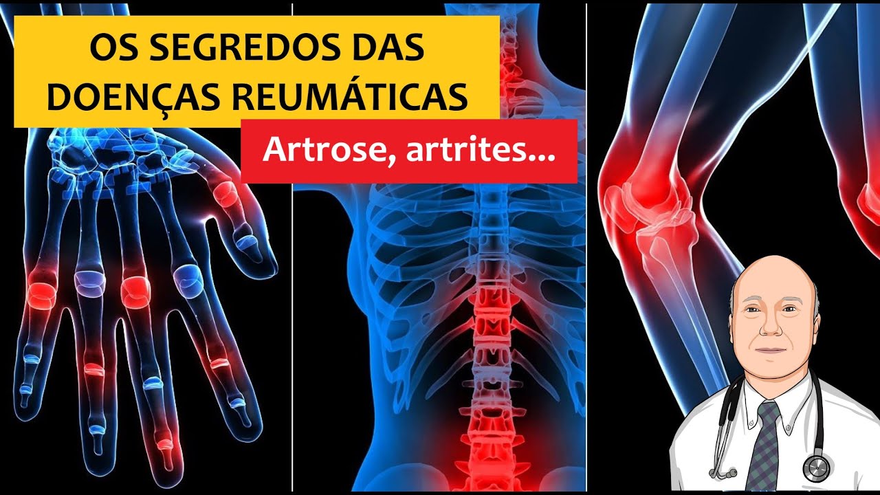 Mistérios dos 140 diferentes reumatismos: artrose, gota, autoimunidade, fibromialgia e suas dúvidas
