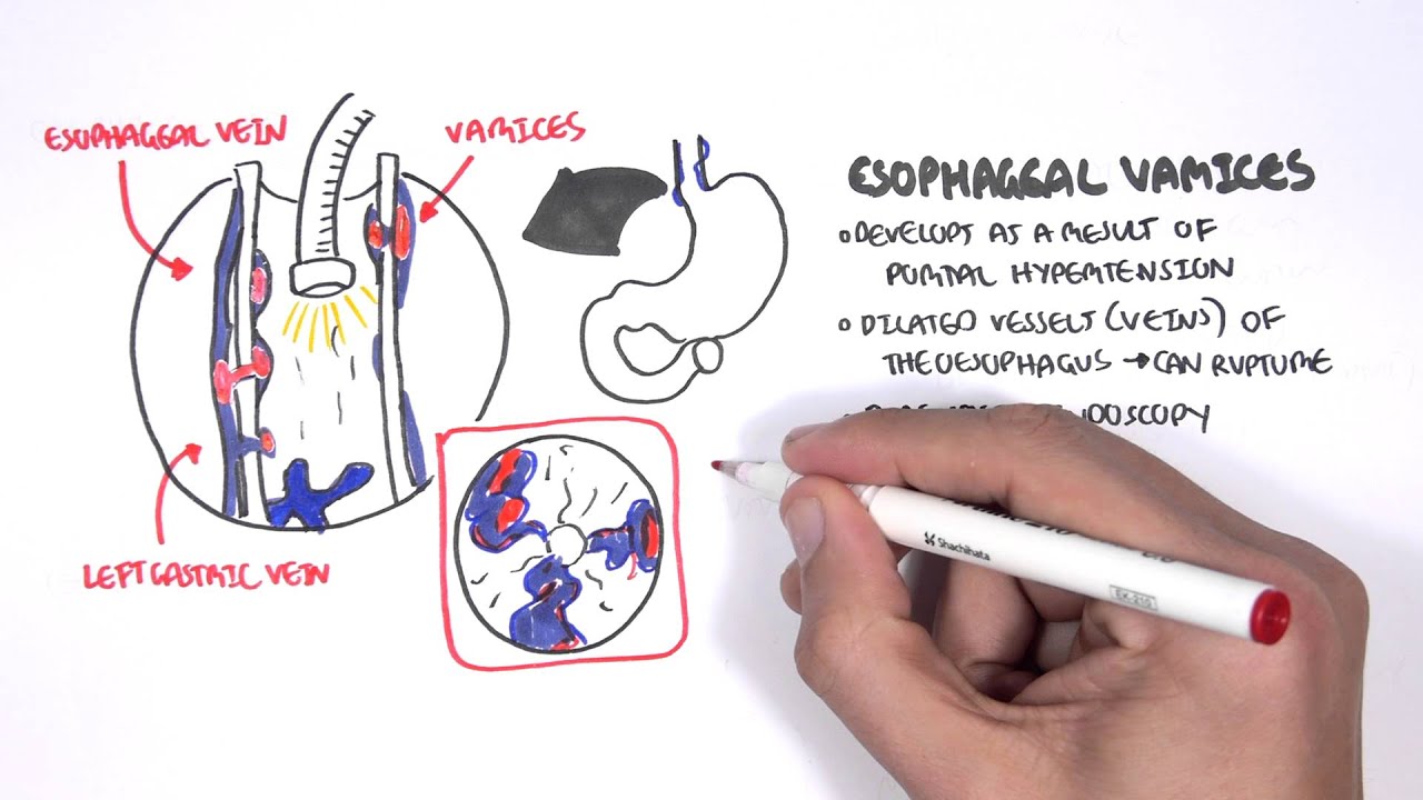 Upper GI Bleed Causes- Overview
