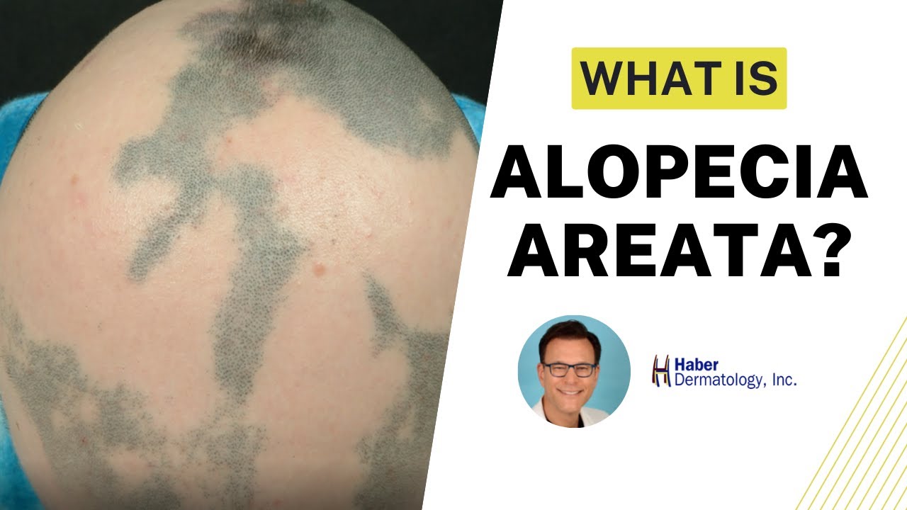 What is Alopecia Areata? Causes, Treatment & Hair Regrowth | Robert Haber, MD