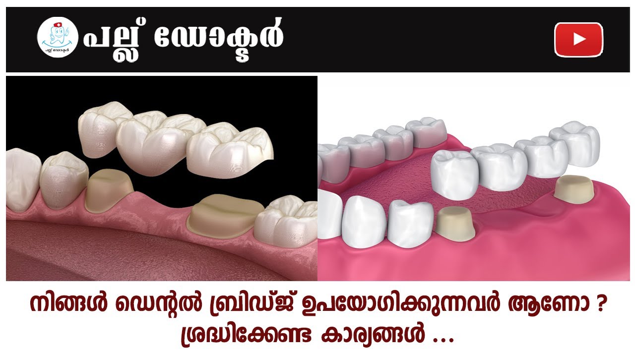 നിങ്ങൾ ഡെന്റൽ ബ്രിഡ്ജ് ഉപയോഗിക്കുന്നവർ ആണോ ?ശ്രദ്ധിക്കേണ്ട കാര്യങ്ങൾ ...