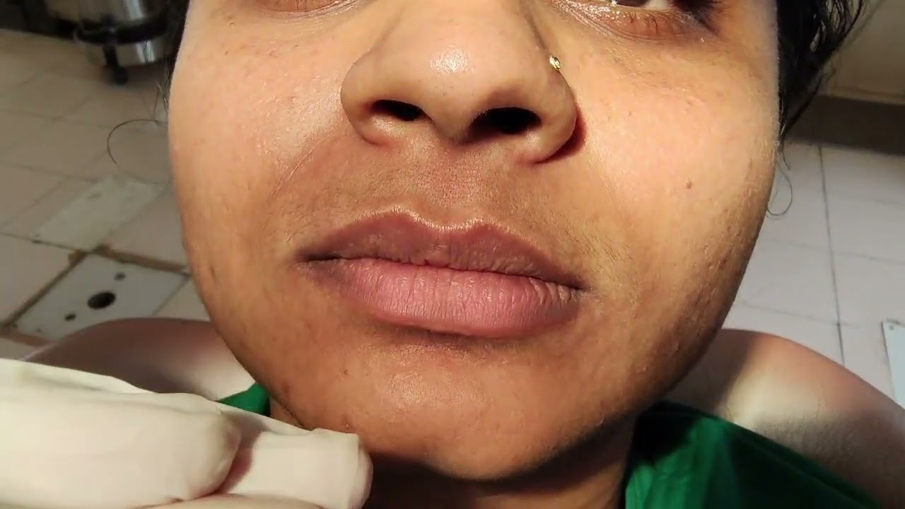 Fremitus Test -Trauma from occlusion