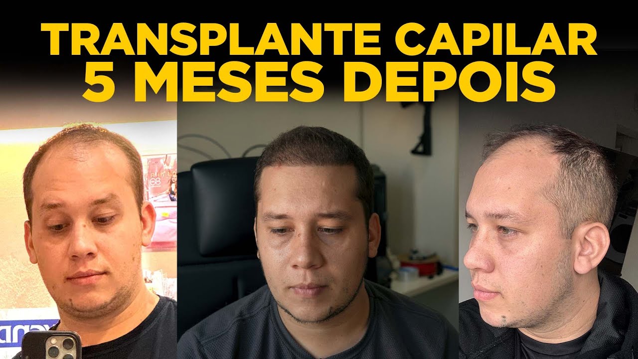 5 MESES DE TRANSPLANTE CAPILAR 5 MIL FOLÍCULOS - 5th hair transplant 5k grafts