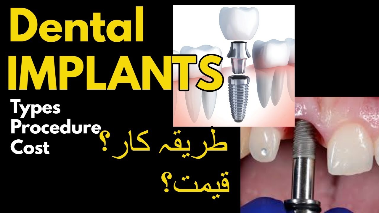 Dental implant Basics, Procedure and cost