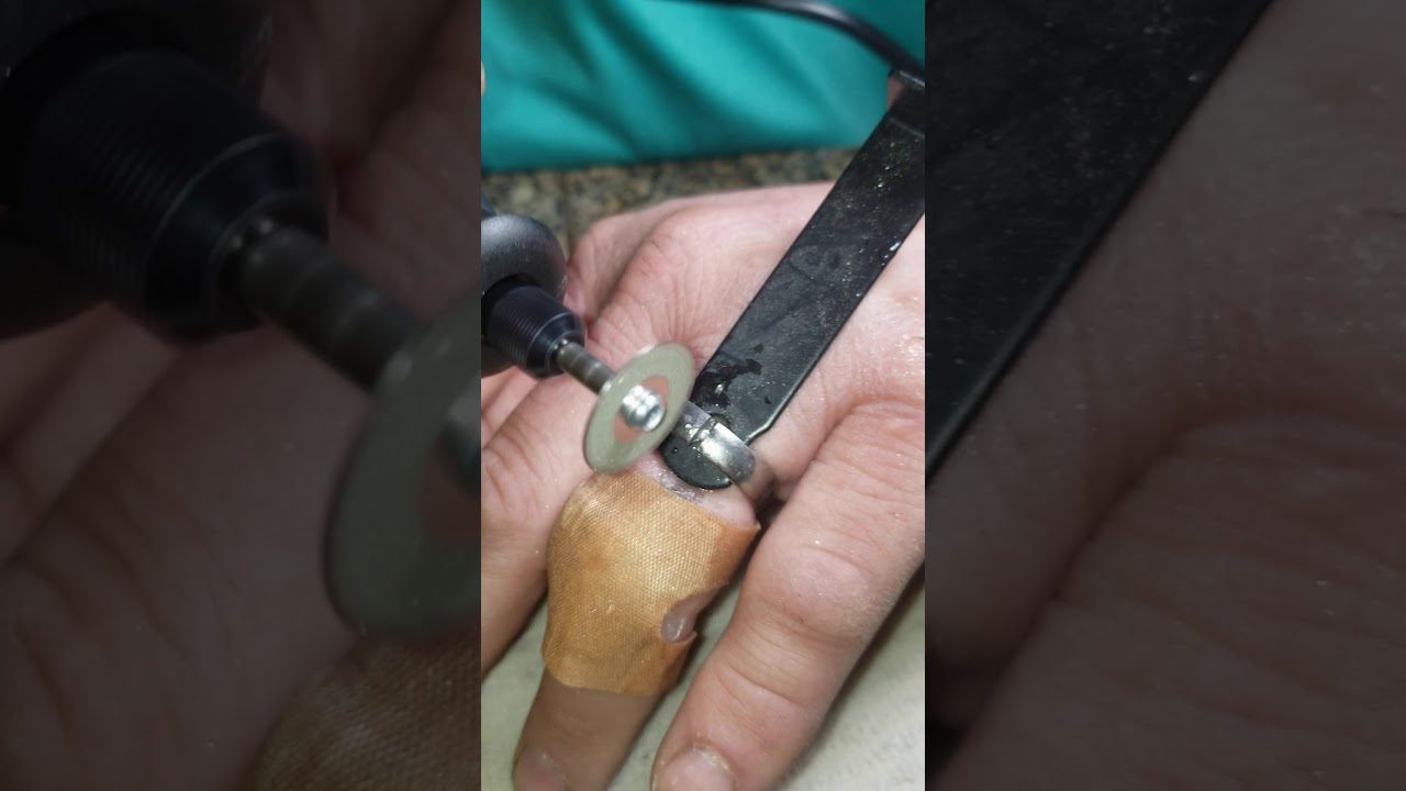 DIY Titanium Ring Removal