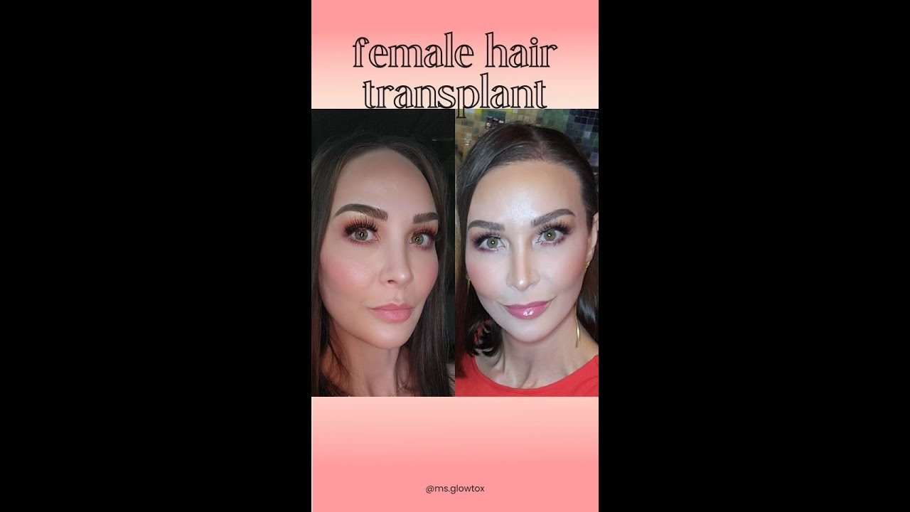 Female Hair Transplant Journey