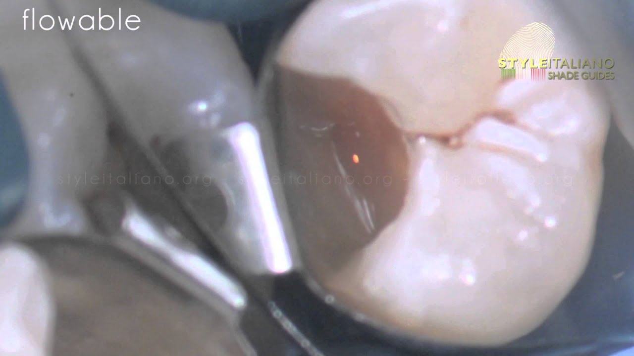 Class II composite direct restoration. Microscope.