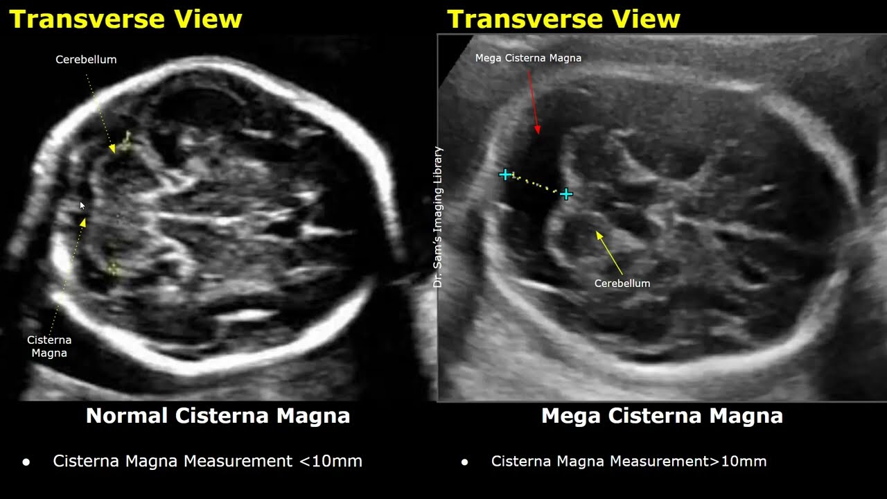 Edwards Syndrome (Trisomy 18) Antenatal Ultrasound Features | Fetal USG Normal Vs Abnormal Images