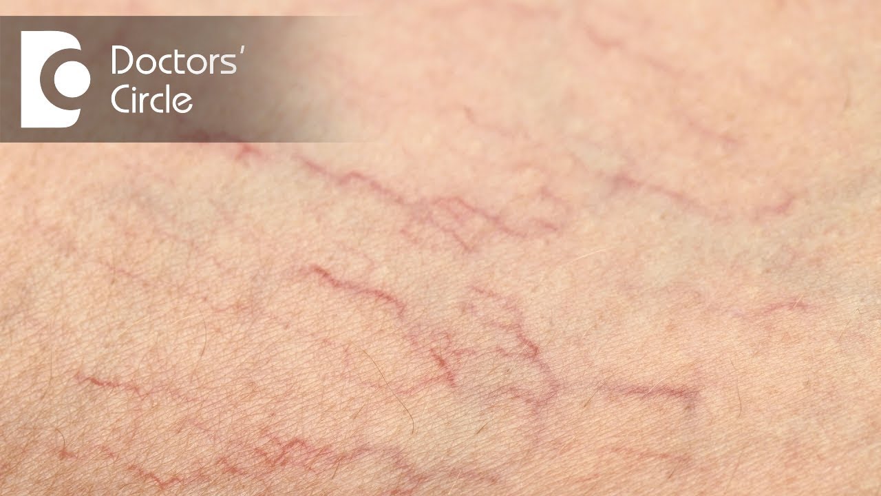 What causes men to experience superficial veins with palpable lump in private parts? - Dr. Nischal K