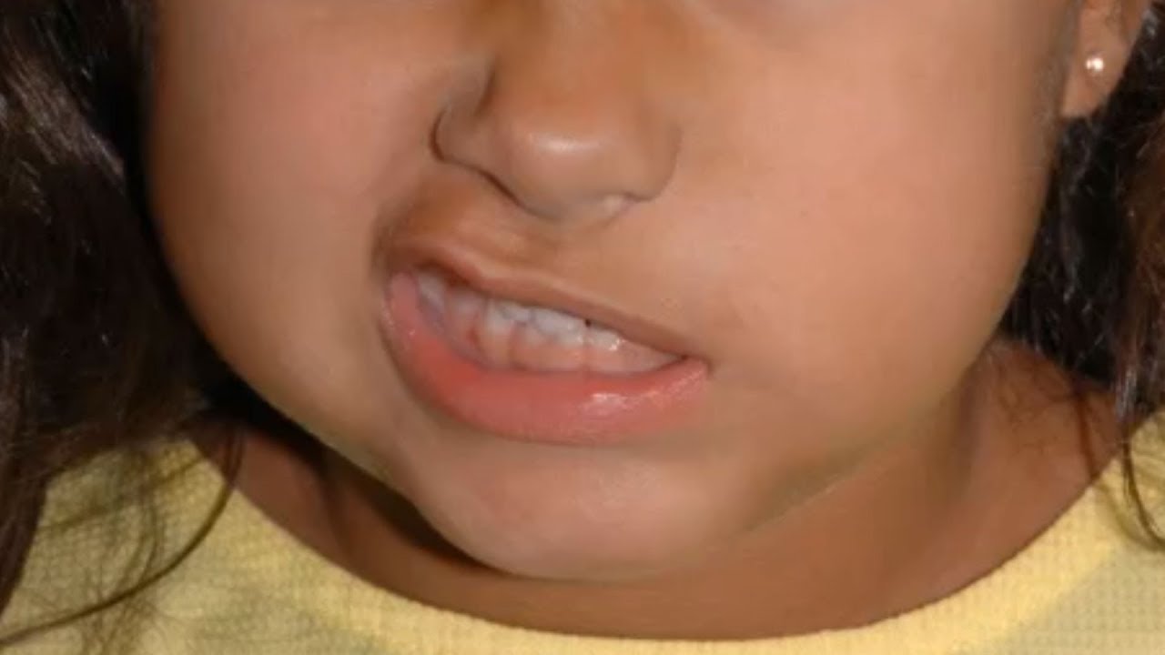 Smile Assessment After Facial Reanimation Surgery