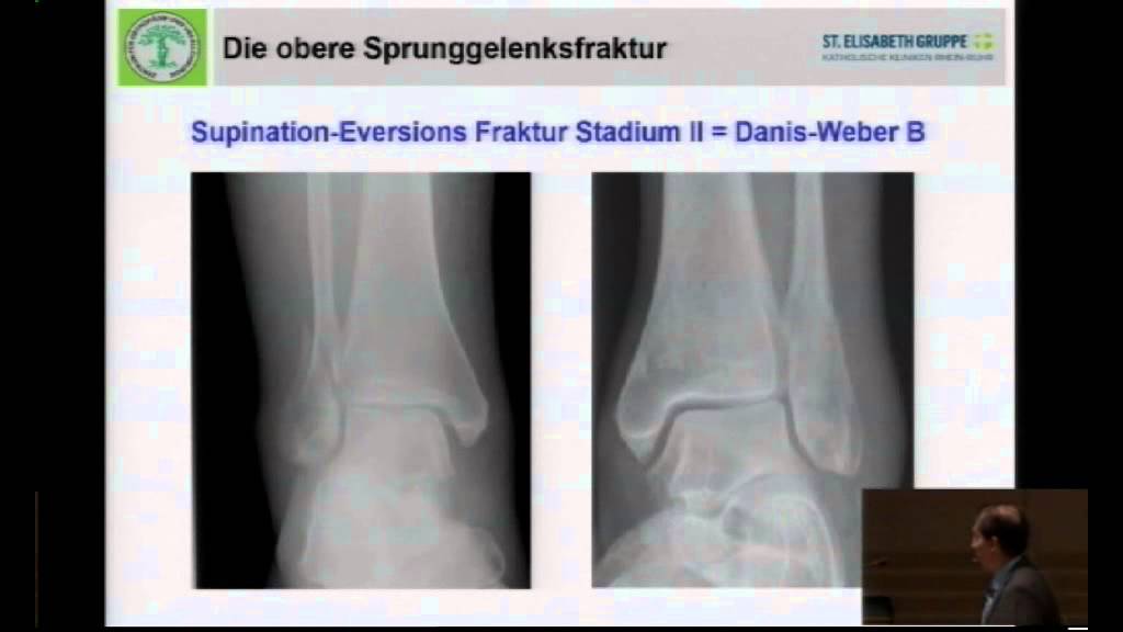 Update: Fuß- und Sprunggelenkschirurgie 05/18 - Frakturen des oberen Sprunggelenkes