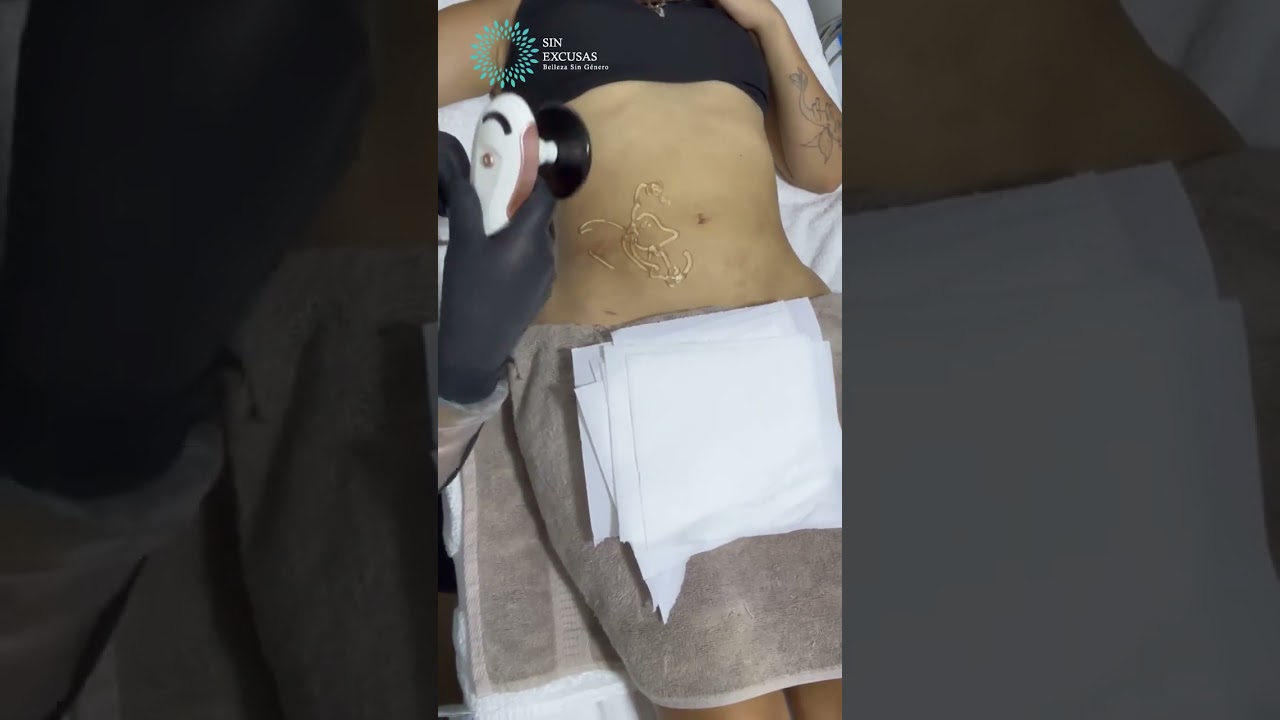¿Tienes fibrosis dura o irregularidades después de una lipo y sientes que no ves resultados?