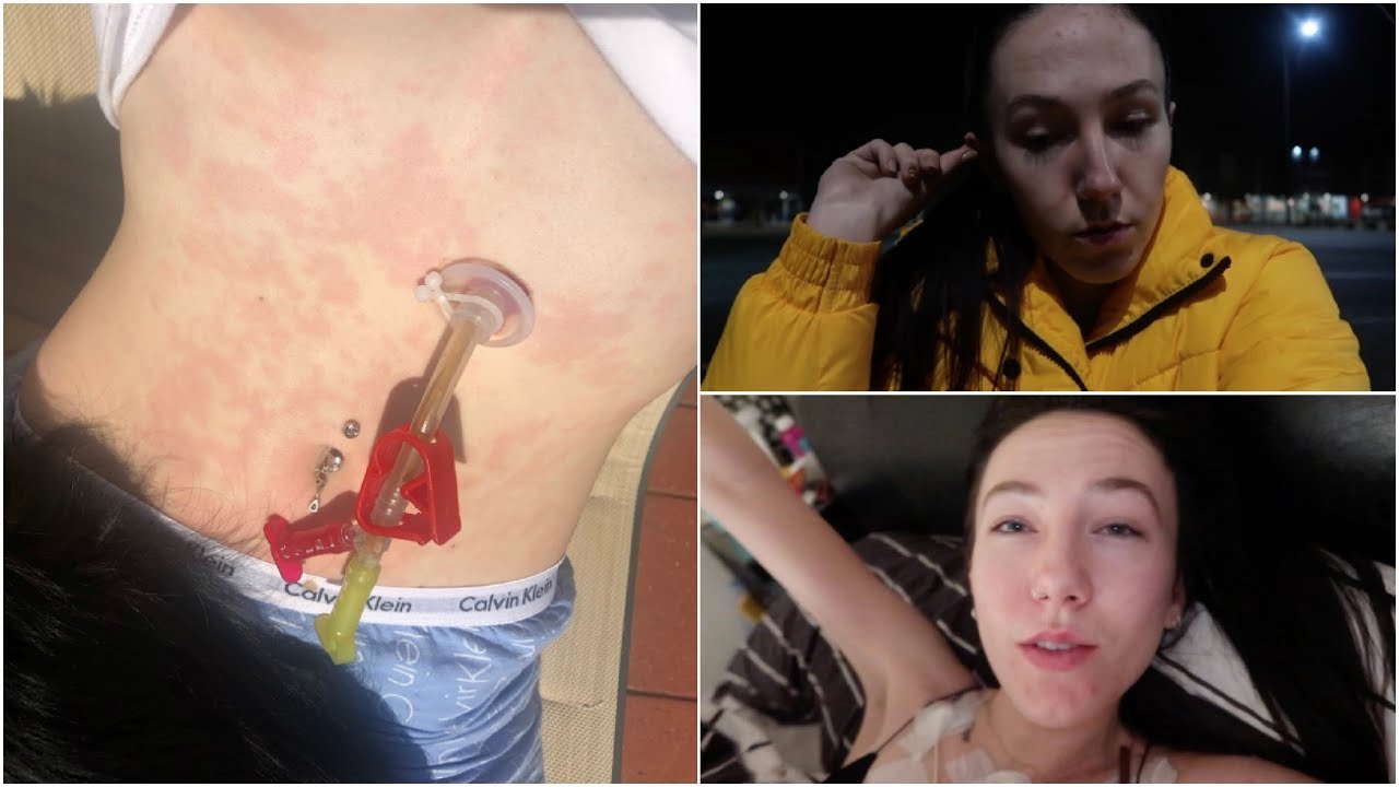 ♡ I'm Allergic to My Feeding Tube! (13.09.18) | Amy's Life ♡