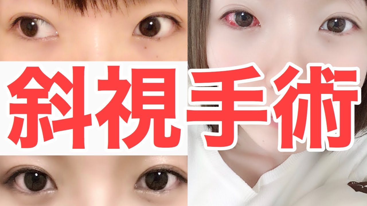 斜視手術で長年のコンプレックスが治りました！【術後の経過写真や費用も公開！】
