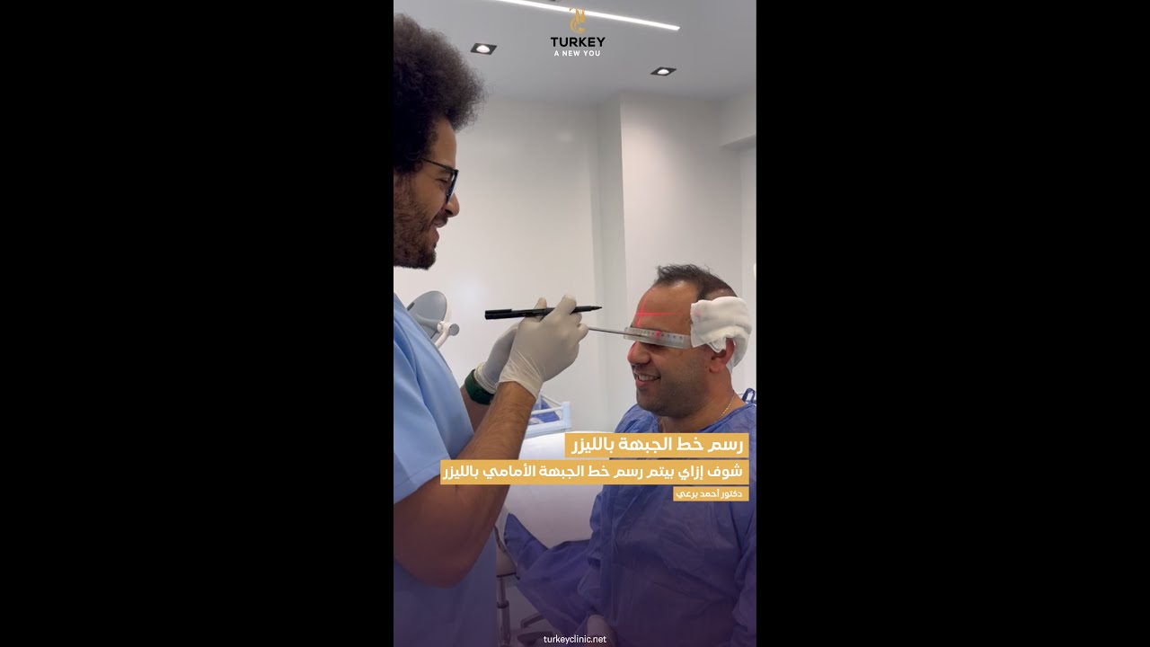 رسم خط الجبهة بالليزر في عملية زراعة الشعر الطبيعي خطوة مهمة جداً | د.احمد برعي - تركي هير كلينك