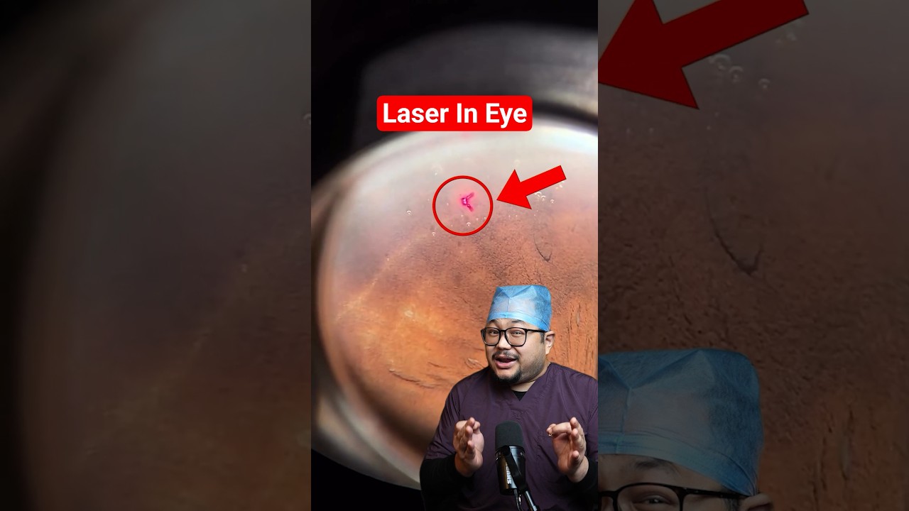 Laser for Saving Vision !
