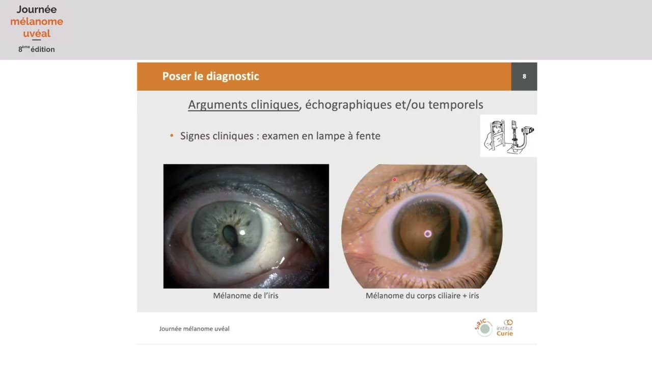 Comprendre le traitement oculaire des mélanomes uvéaux