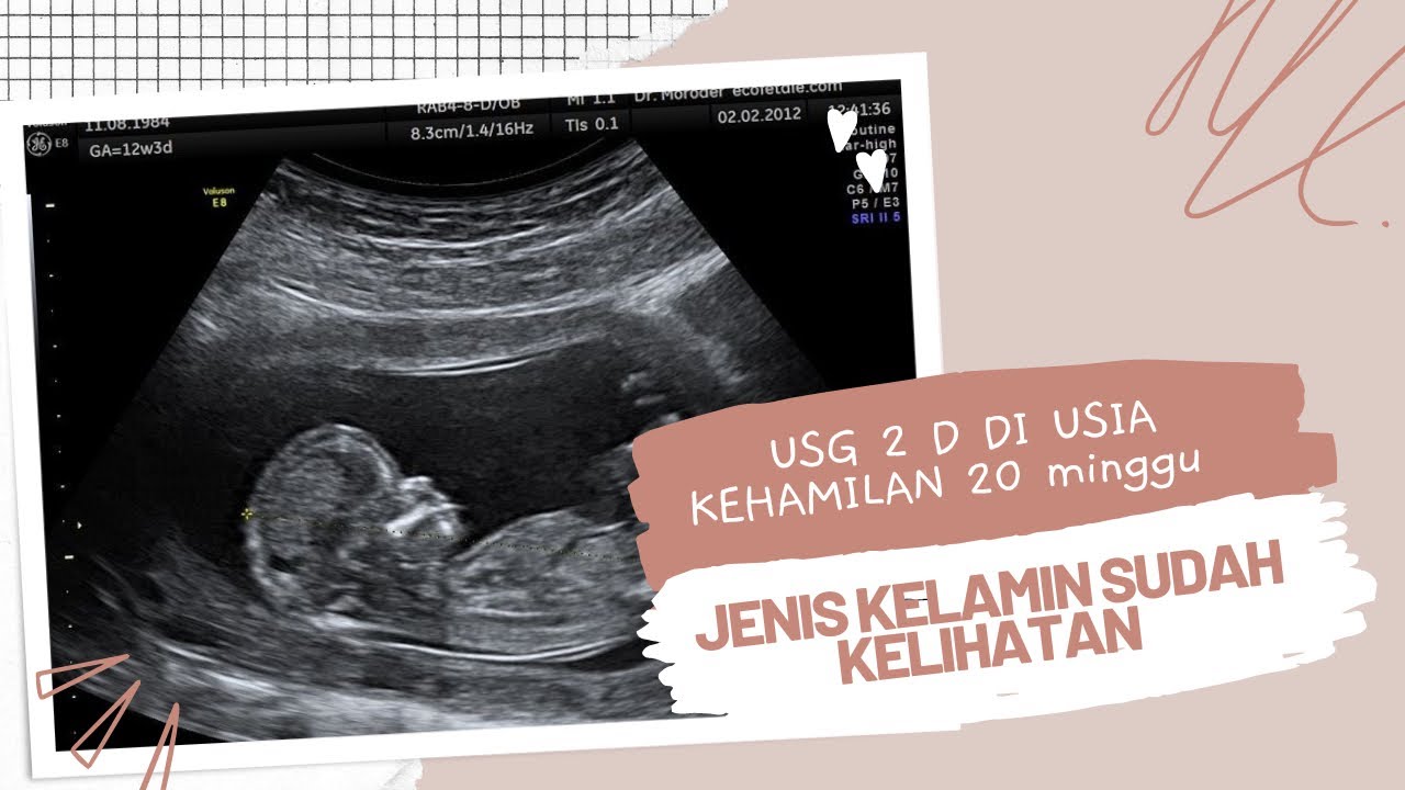 USG 2 D diusia kehamilan 20 Minggu sudah kelihatan jenis kelamin di RS JAMPANG KULON SUKABUMI