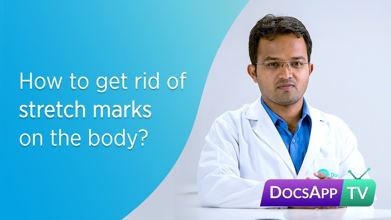 How to get rid of Stretch Marks on the Body?- Treatment for Stretch Marks #AsktheDoctor