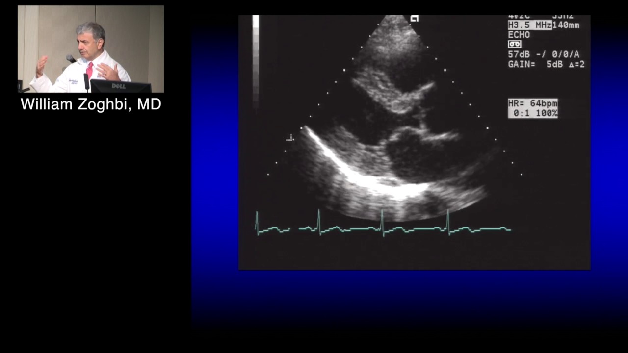 Principles of Echo Doppler (William Zoghbi, MD) September 13, 2016