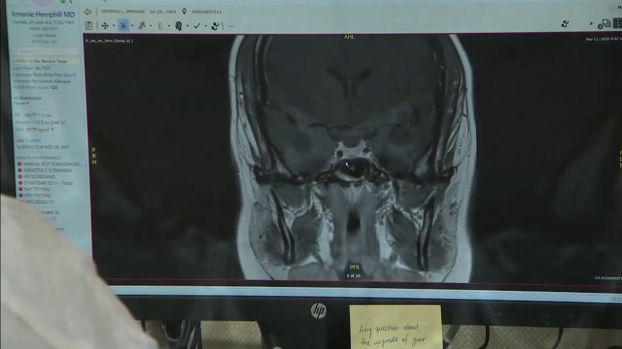 Rare condition called Cushing&rsquo;s Disease may be underreported