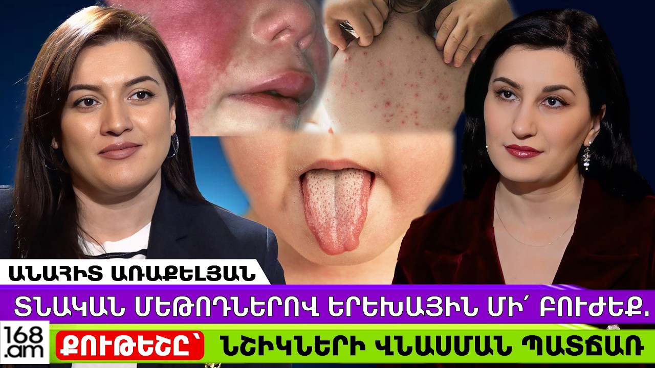 Տնական մեթոդներով երեխային մի՜ բուժեք. Քութեշը`  նշիկների վնասման պատճառ