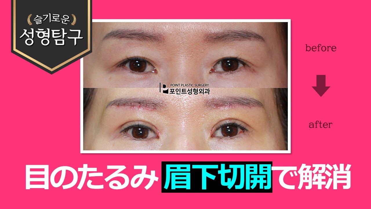 【韓国二重整形】まぶたのたるみ、眉下切開で自然な仕上がりに