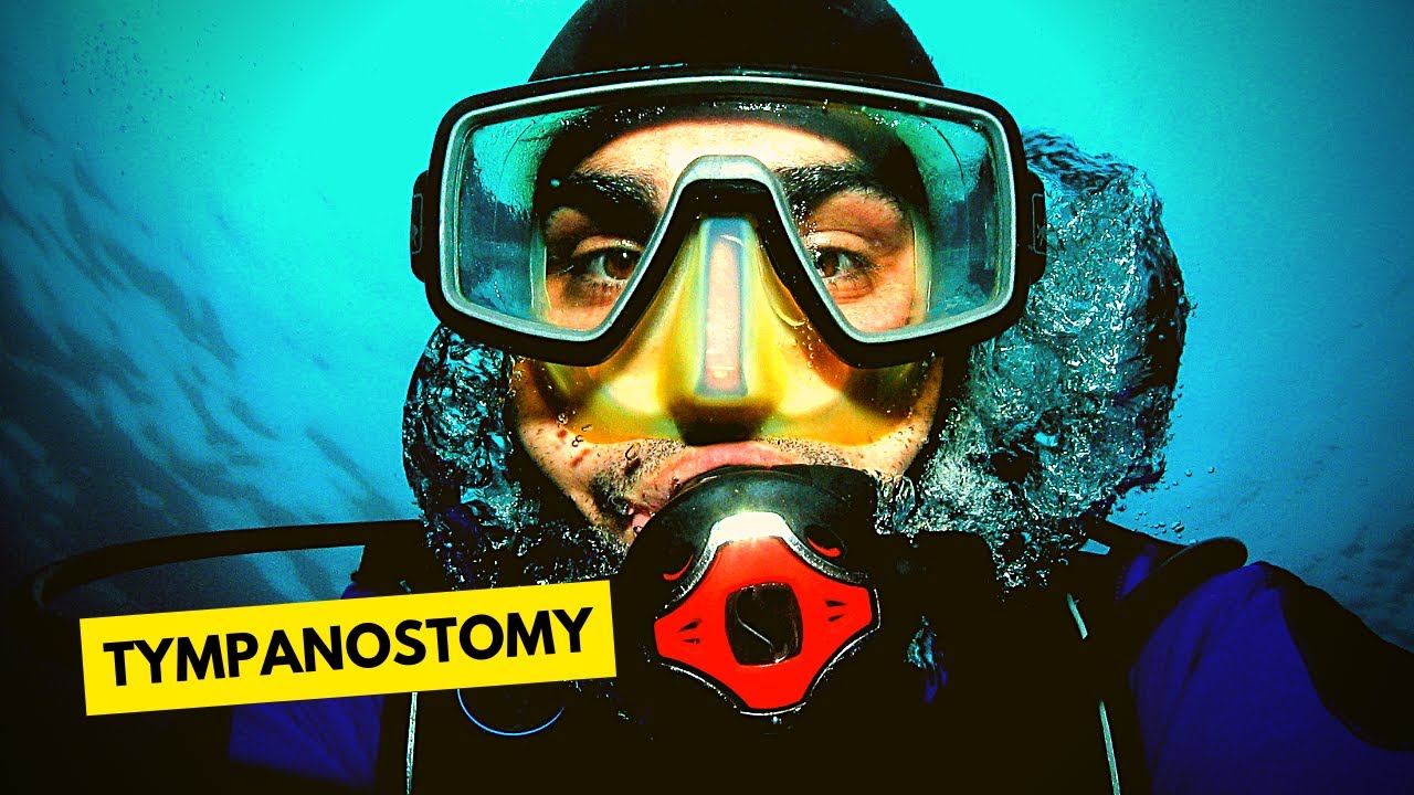 Tympanostomy Tubes