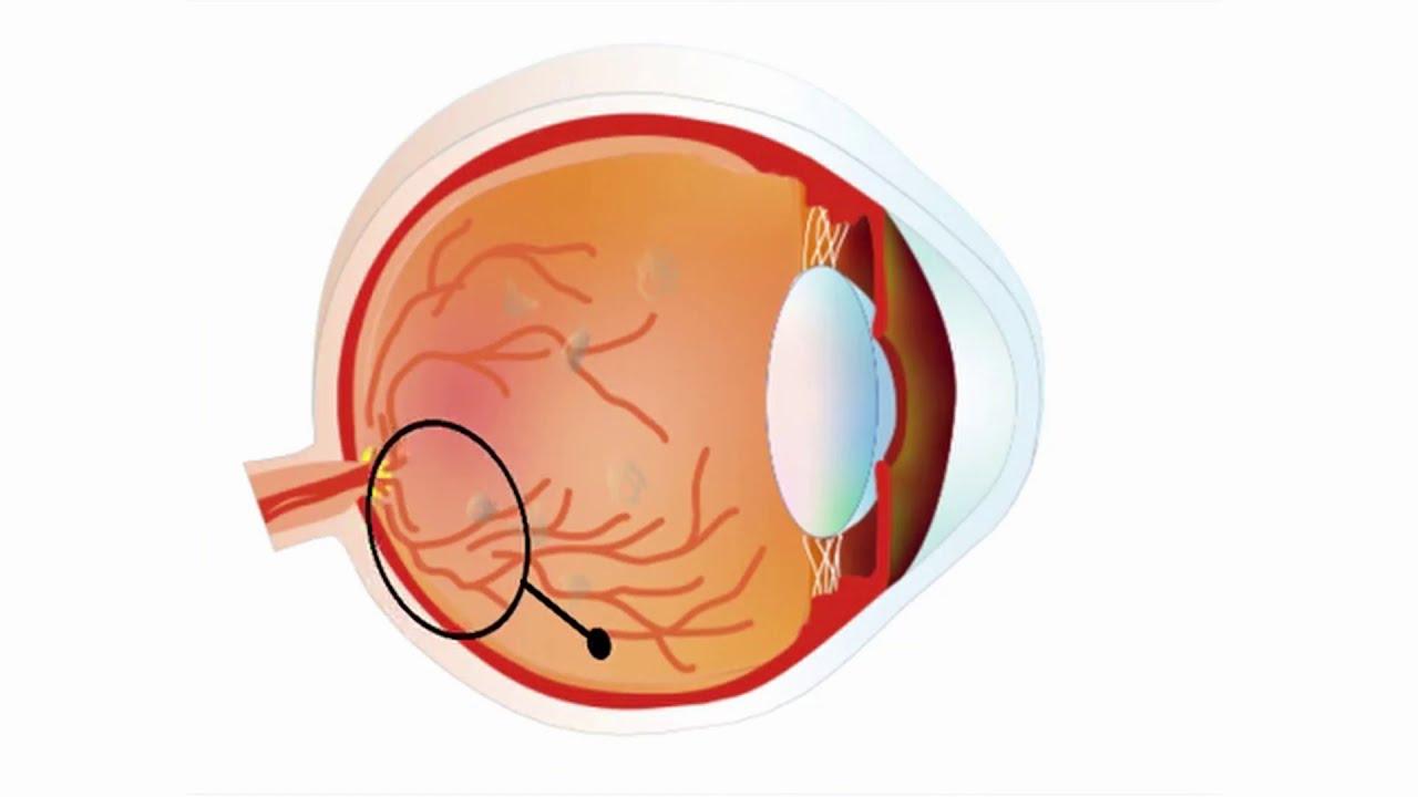 Glaskörpertrübungen - worauf Sie achten sollten I Die Augenpartner