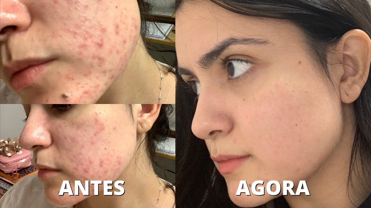 como me livrei das minhas acnes + rotina de skincare [PRODUTOS COREANOS 🇰🇷]