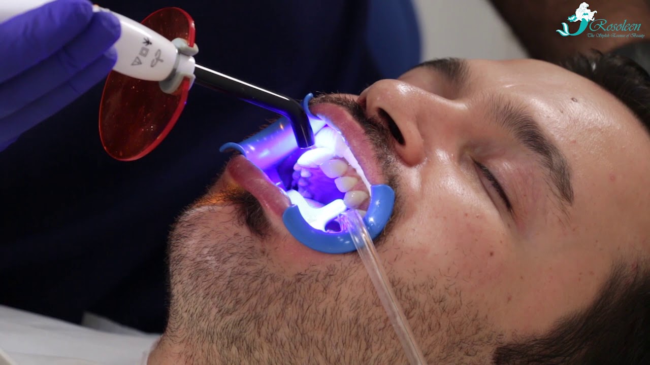 حشوات تجميلية للأسنان