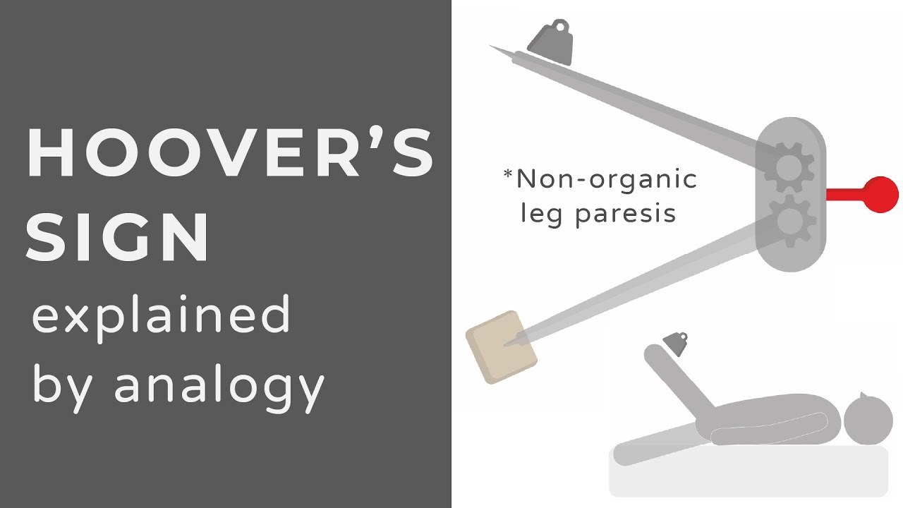 Hoover's Sign | Animation | Explained Conceptually