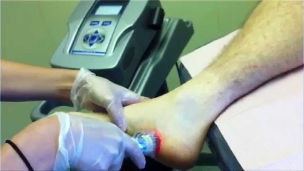 Radial Pressure Wave Therapy for Foot Pain - Toronto, Ontario - Podiatrist - Sheldon Nadal, DPM