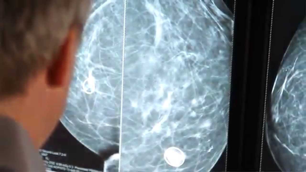 Gastrointestinal (GI) Oncology