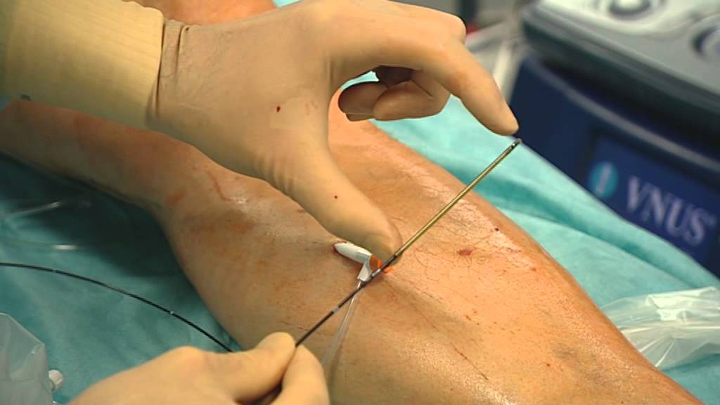 Neue Therapie gegen Krampfadern: schnell, schonend, sicher
