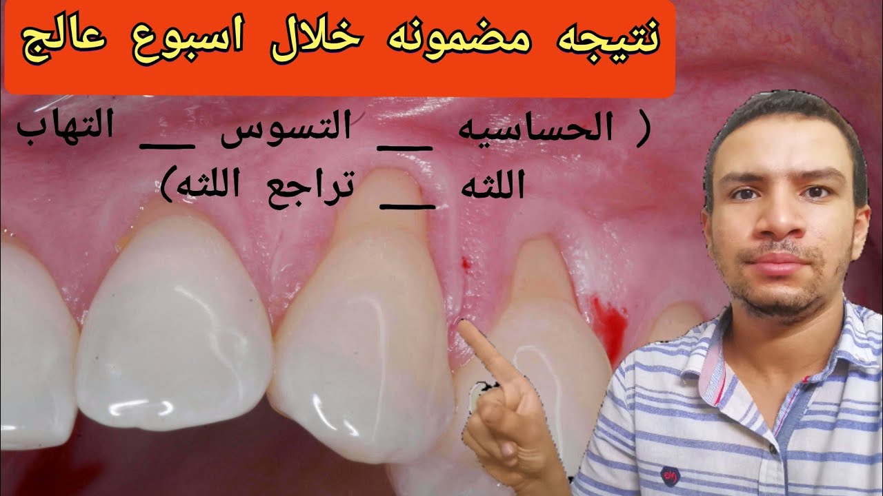 5 أشياء لو فعلتها يوميا سوف تتخلص من ( حساسيه الاسنان _ تسوس الاسنان _ تراجع اللثه _ التهاب اللثه)