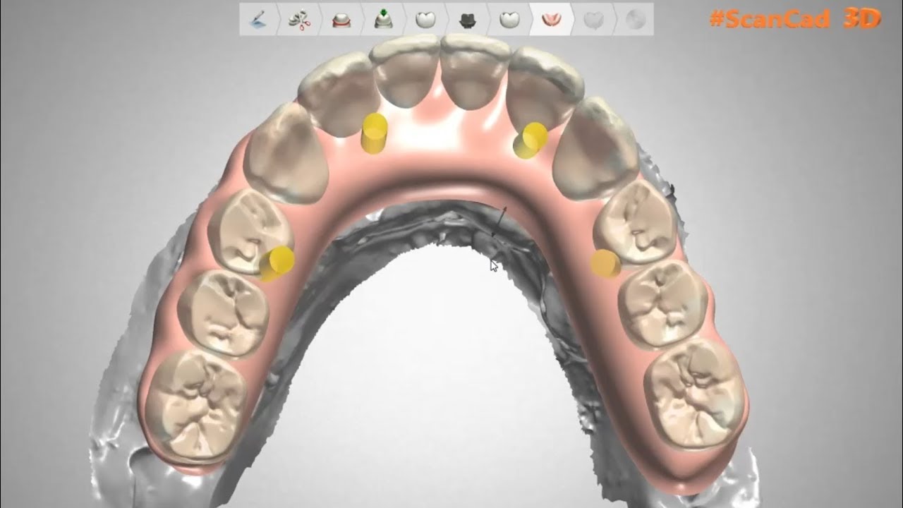 Fast 3shape gingiva