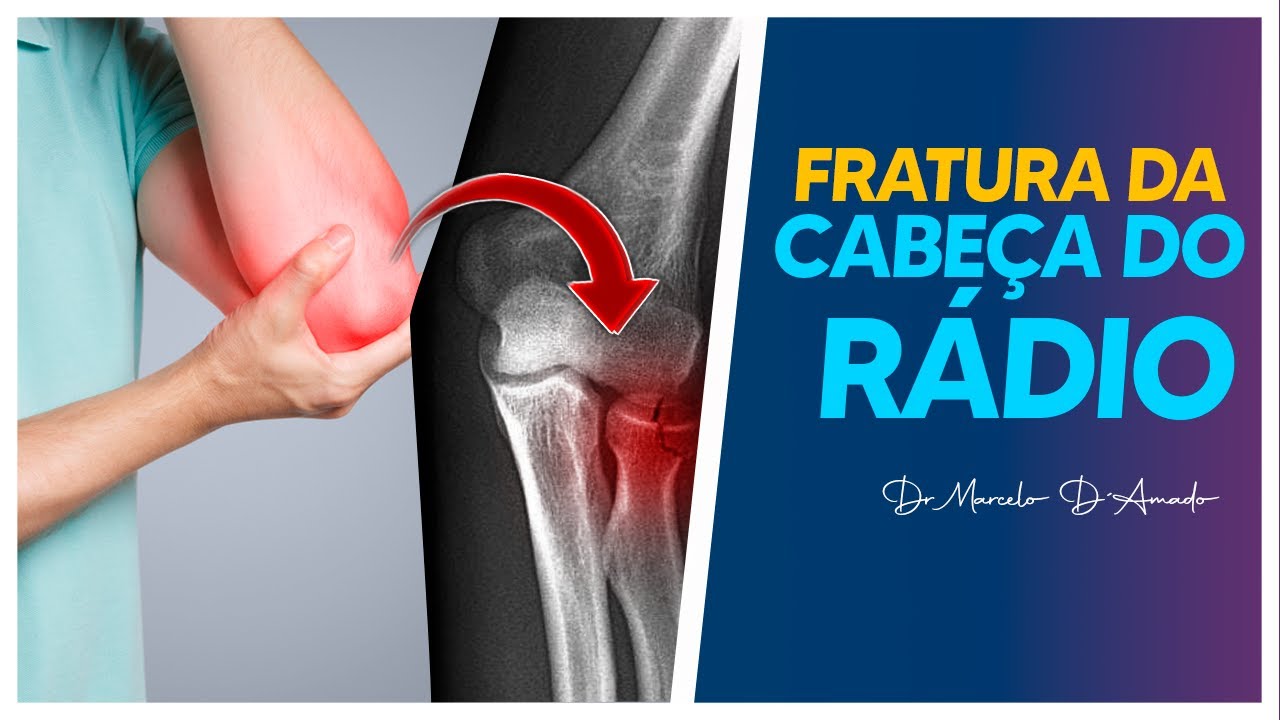 FRATURA DA CABEÇA DO RÁDIO | TIPOS, SINTOMAS, DIAGNÓSTICO E TRATAMENTO.