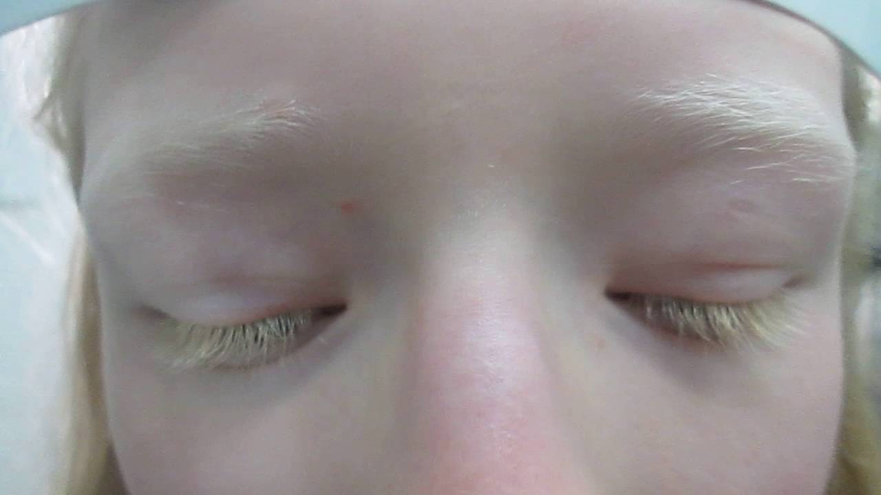 albinismo nistagmus