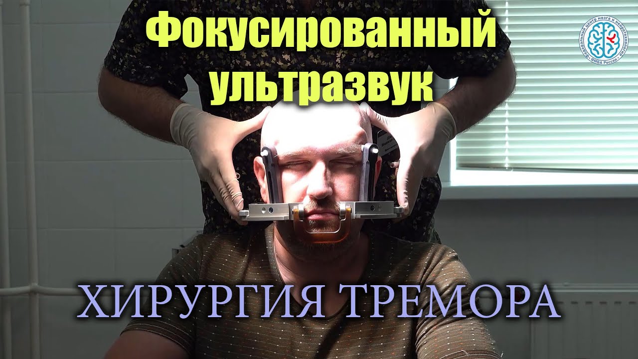 Фокусированный ультразвук (ФУЗ) - малоинвазивная операция. Хирургическое лечение болезни Паркинсона.